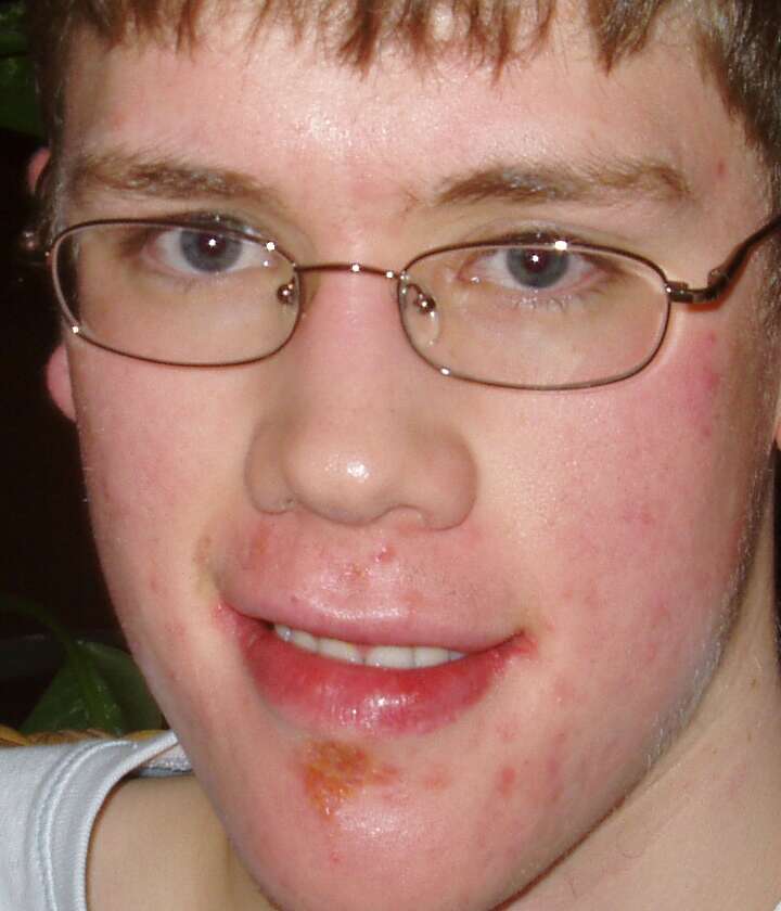 Acne On Lip